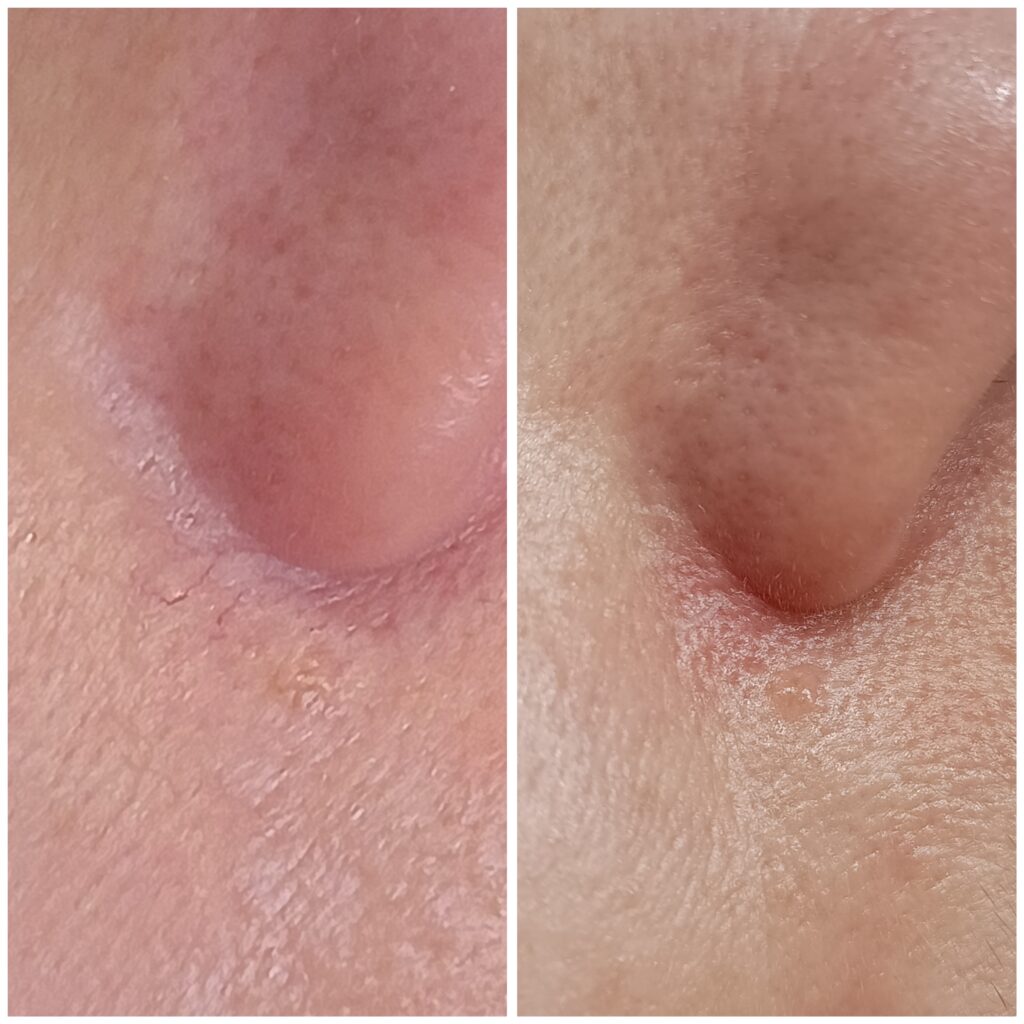 Zamykanie Naczynek  Znamion Rubinowych Bydgoszcz 05